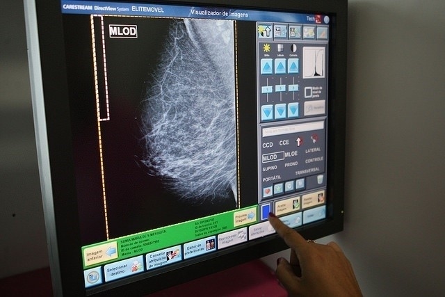 674 fuentecanteñas se someterán a mamografías en enero dentro del Programa de Detección Precoz del Cáncer de Mama