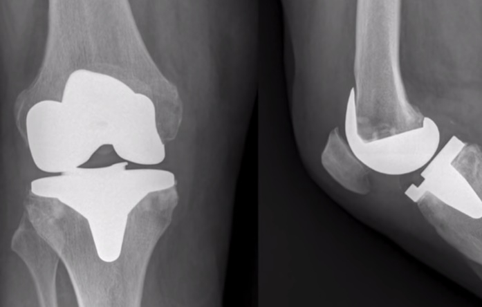 El proceso de la artroplastia en la rodilla