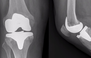 El proceso de la artroplastia en la rodilla